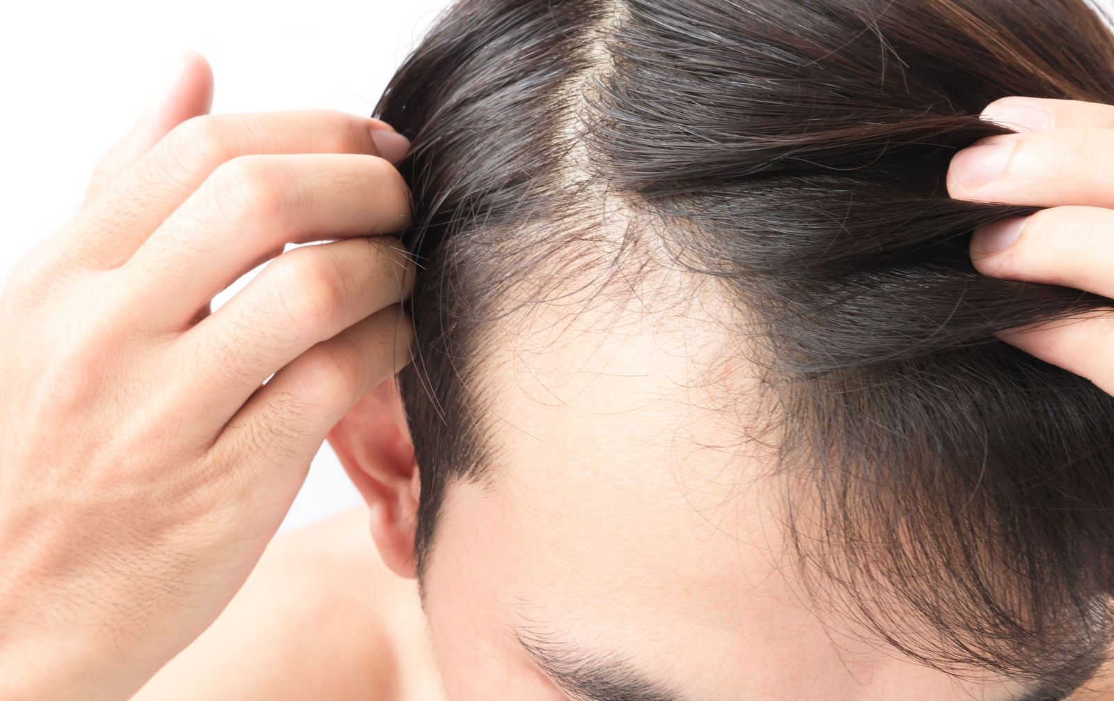 DIY Hair Oil for Men – Fight Balding